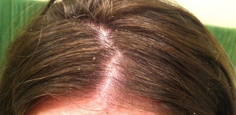 Dry Scalp