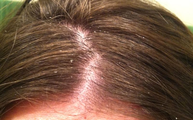Dry Scalp