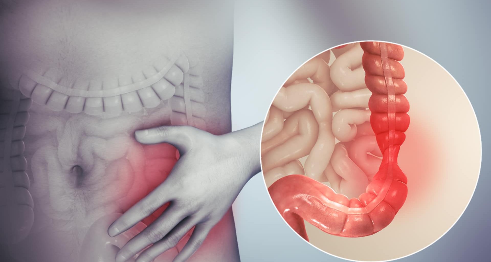 Irritable Bowel Syndrome
