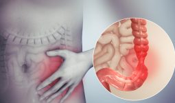 Irritable Bowel Syndrome