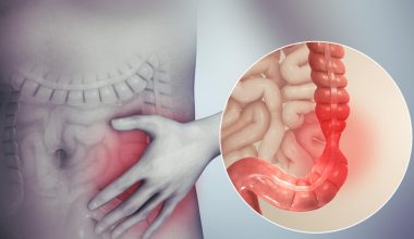 Irritable Bowel Syndrome