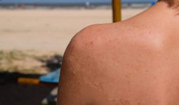 Peeling Skin