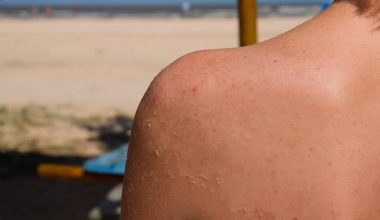 Peeling Skin