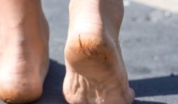 cracked heels