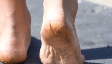 cracked heels