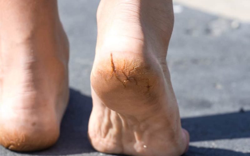 cracked heels