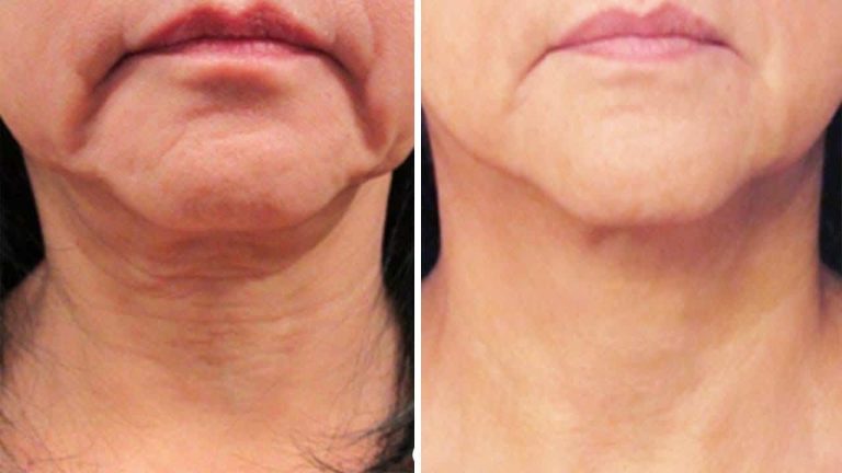 Neck Look Younger