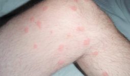 Flea Bites on Humans During Pregnancy