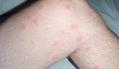 Flea Bites on Humans During Pregnancy