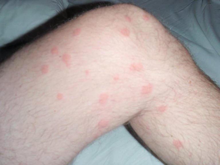 Flea Bites on Humans During Pregnancy