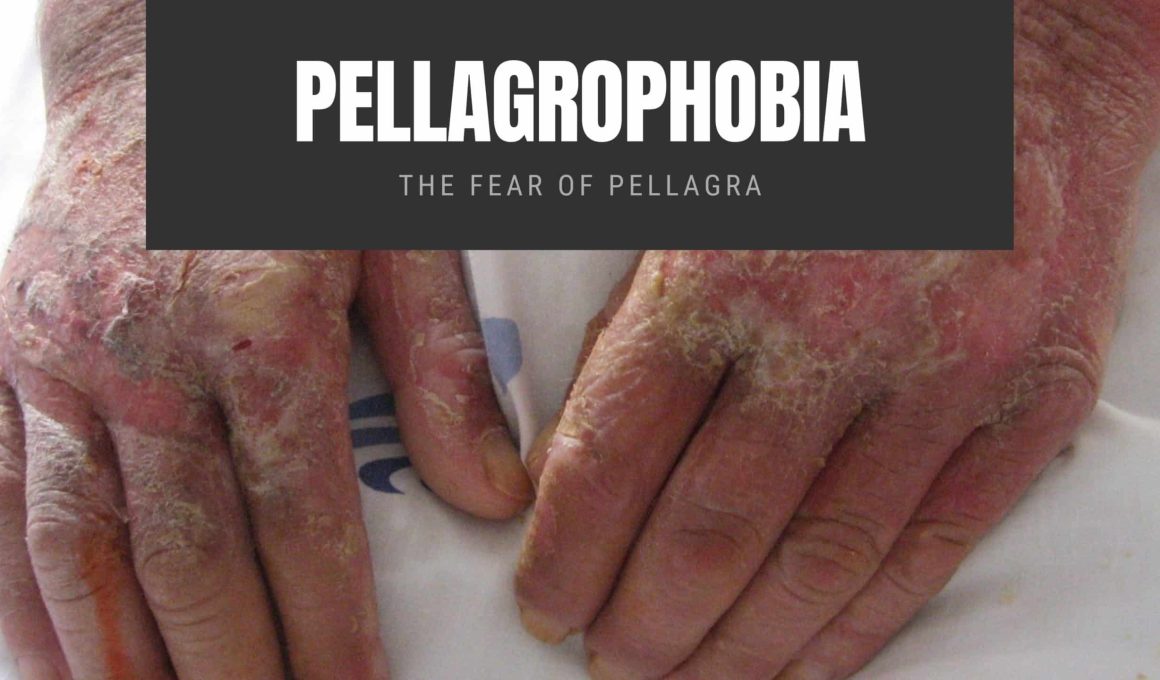 Pellagrophobia The Fear of Pellagra