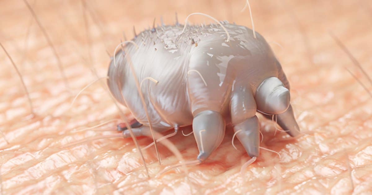 Scabiophobia: The Fear of Scabies