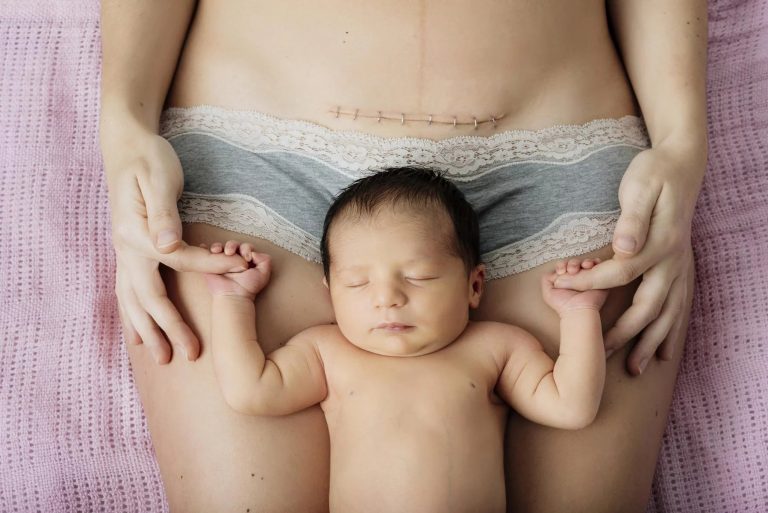 C-section (Cesarean Section)