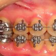 Different Types of Bracket Braces