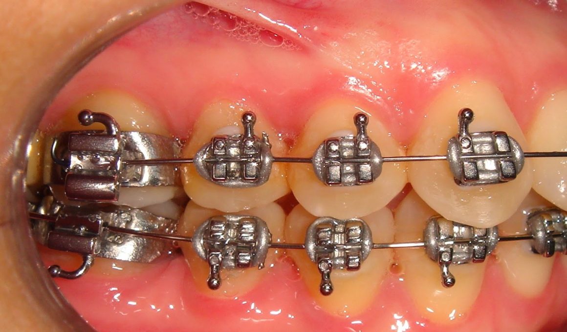 Different Types of Bracket Braces