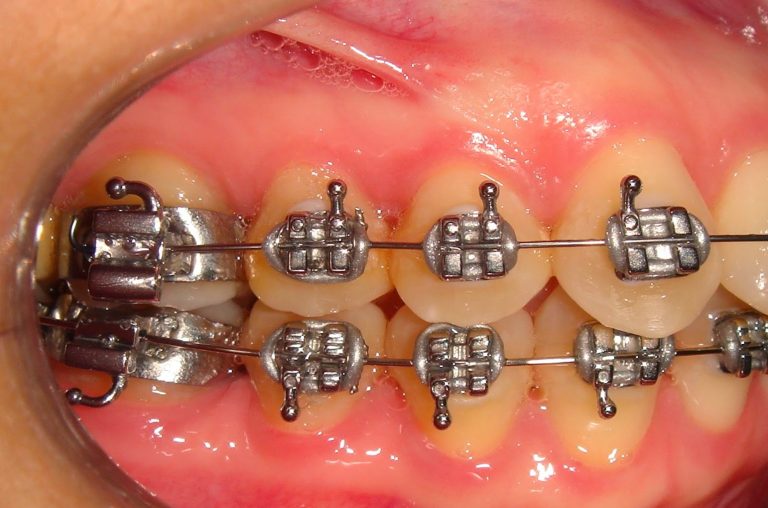 Different Types of Bracket Braces