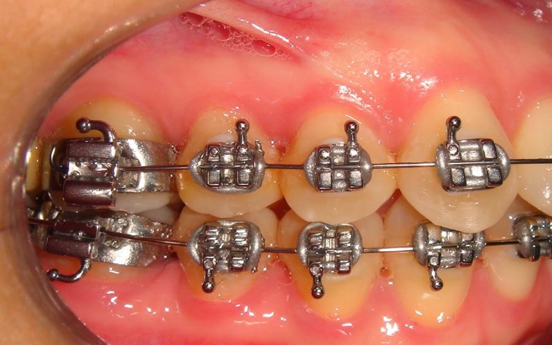 Different Types of Bracket Braces