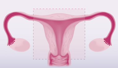 Pros and Cons of a Hysterectomy