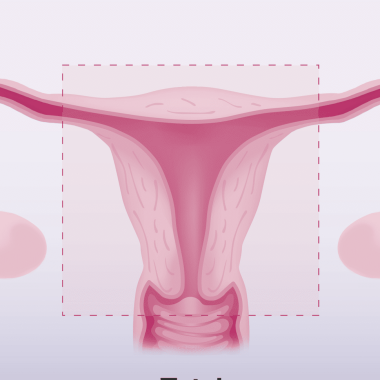 Pros and Cons of a Hysterectomy