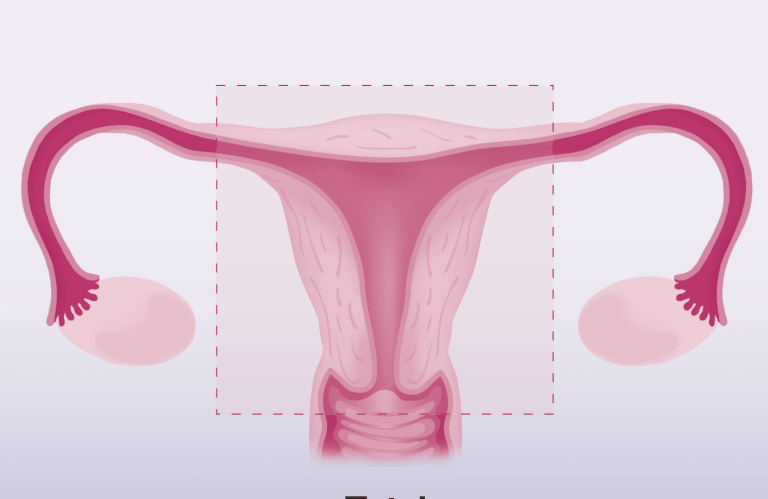 What Are the Pros and Cons of a Hysterectomy?