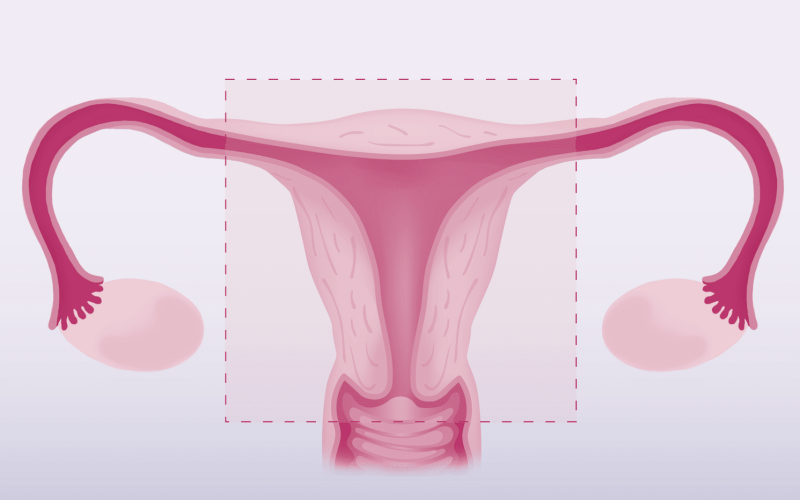 Pros and Cons of a Hysterectomy