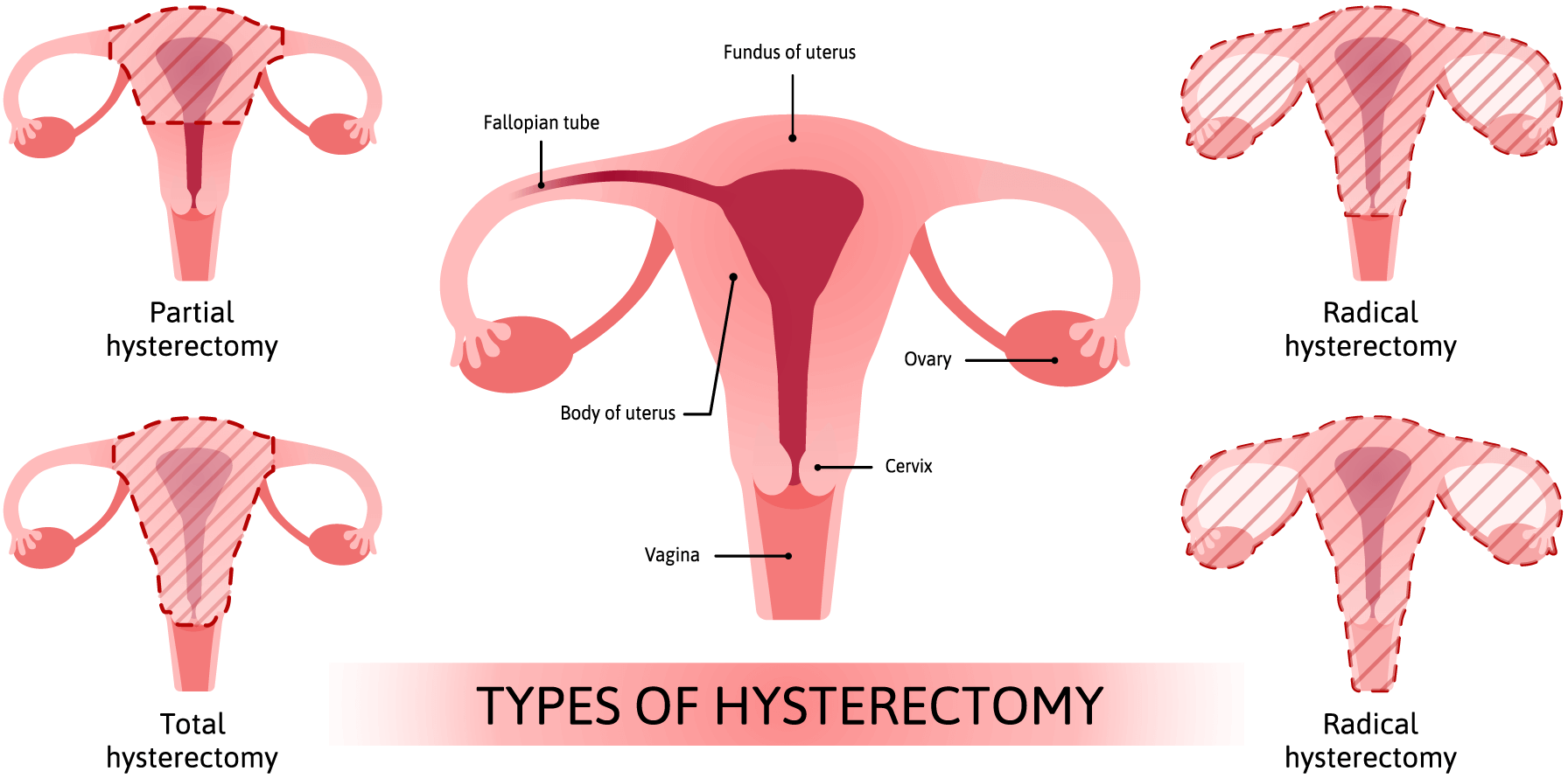 What Are the Types of Hysterectomies