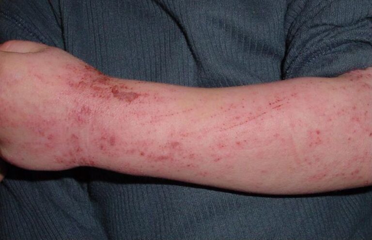 Fruits That Can Cause Latex-Fruit Syndrome
