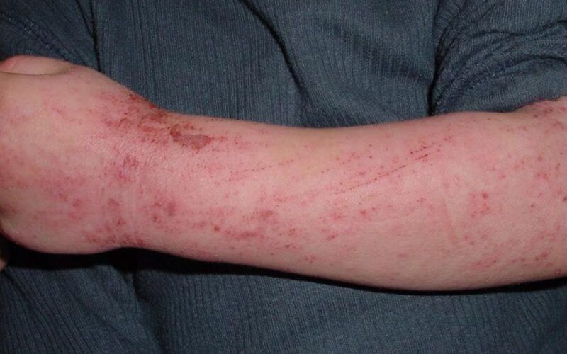 Fruits That Can Cause Latex-Fruit Syndrome
